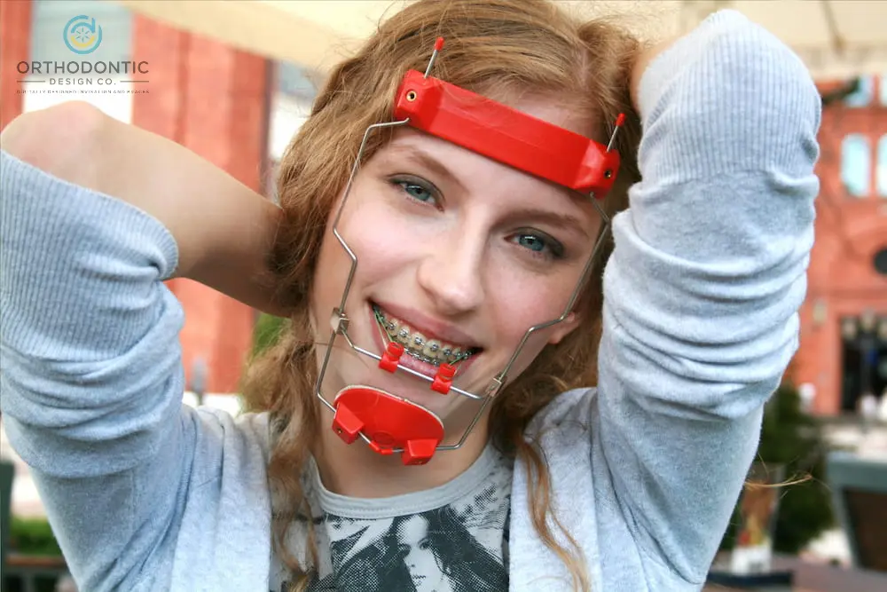 Person smiling, wearing an reverse pull headgear braces in Madison, AL, holding their hair with hands behind their head.