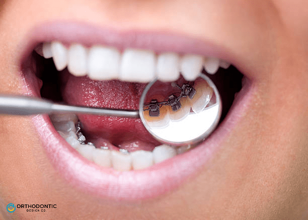 Close-up of a mouth with a dental mirror showing lingual braces on the lower teeth at Orthodontic Design Co in Huntsville, AL