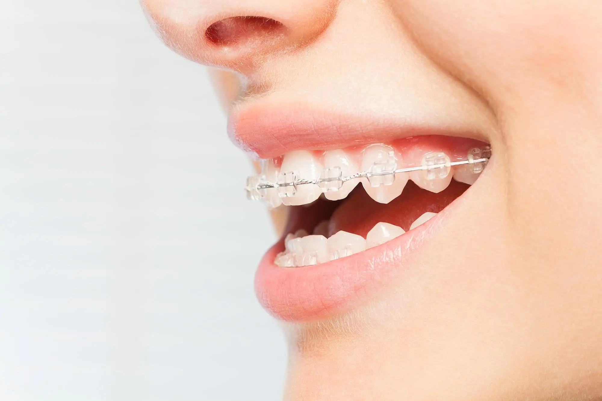 A person smiles, displaying clear braces on their upper and lower teeth at Orthodontic Design Co. Orthodontics in Huntsville, AL.