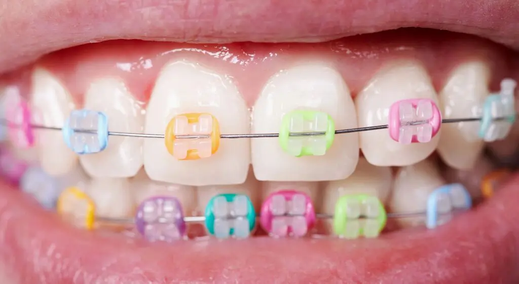 A close-up image shows teeth with dental braces, highlighting clear or ceramtic braces and metal wires, as provided by Orthodontic Design Co. Orthodontics in Madison and Huntsville, AL.