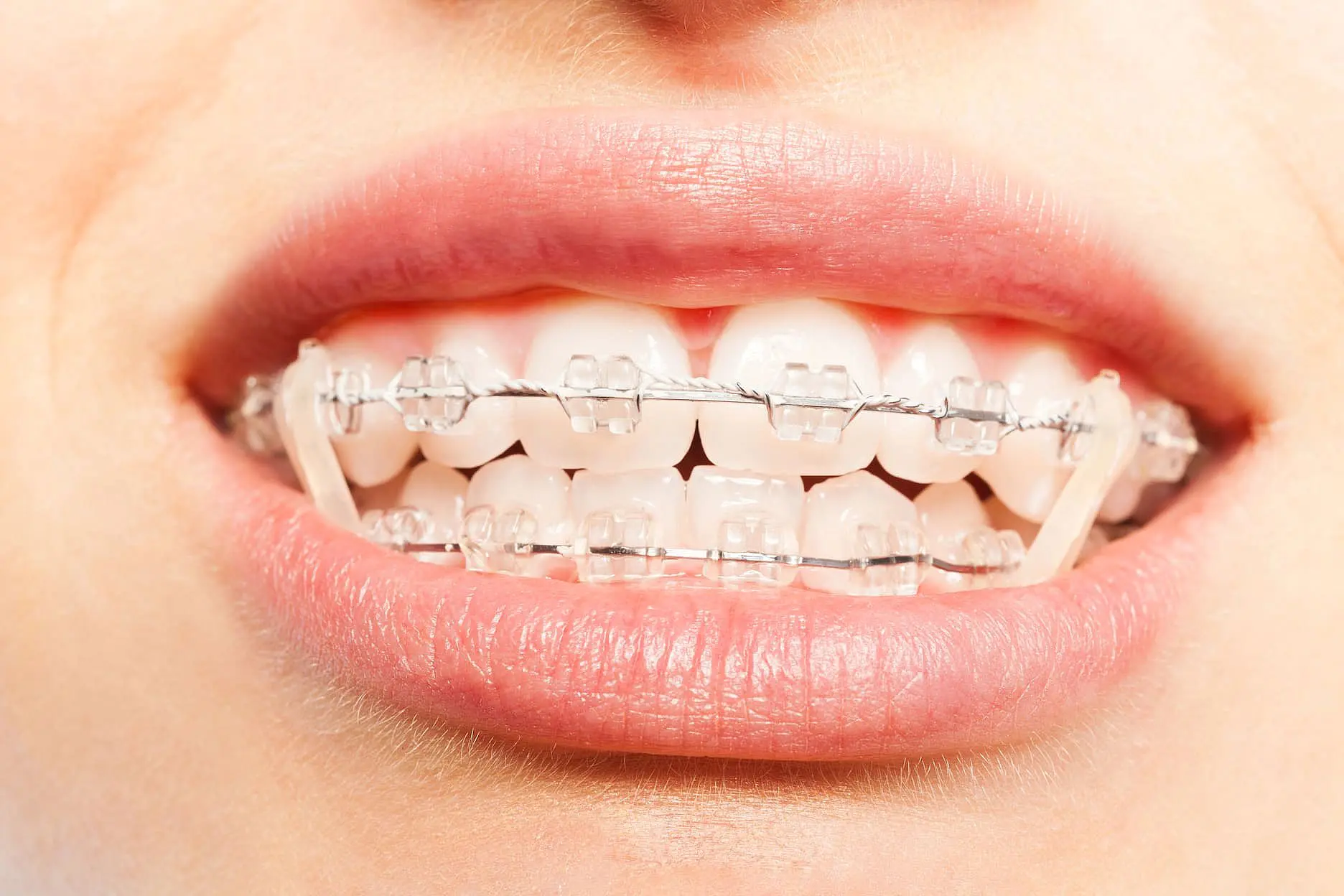 A close-up shows clear ceramic braces and metal wires on a patient's teeth, as part of treatment by Orthodontic Design Co. Orthodontics in Madison and Huntsville, AL.