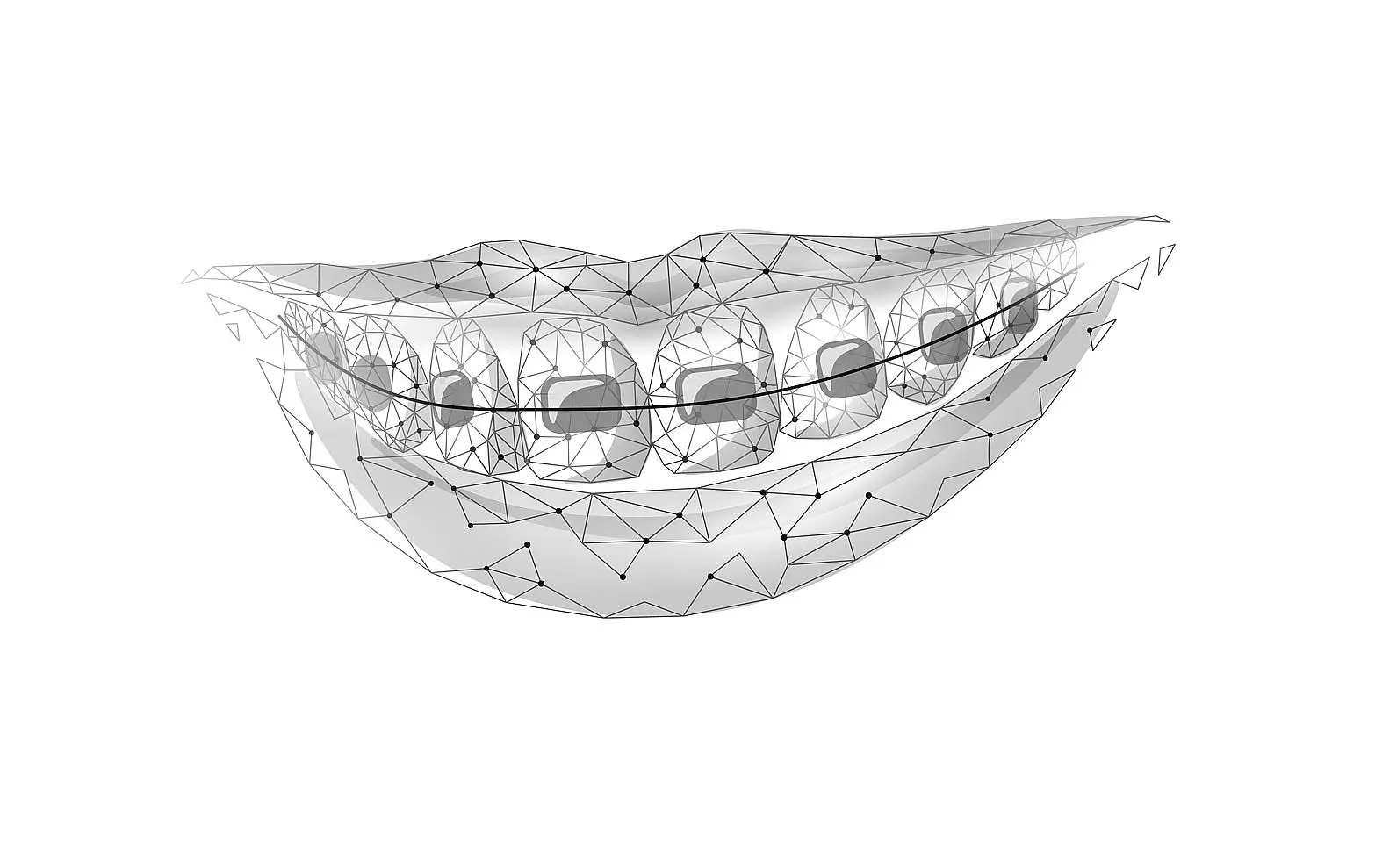 Custom braces means faster treatment and less pain