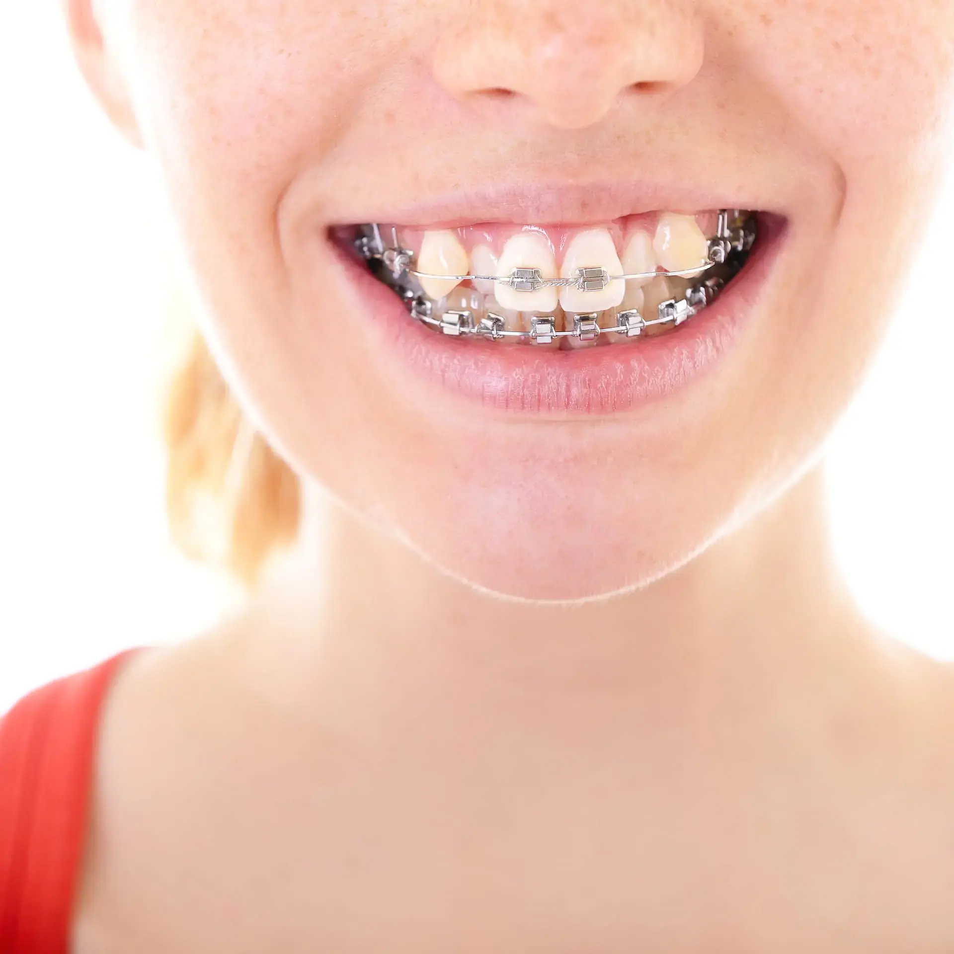 A close-up shows a person in a red top smiling, revealing metal braces and some dental discoloration—possibly during a visit to Orthodontic Design Co. Orthodontics in Madison and Huntsville, AL, which also specializes in children's orthodontic care. A close-up shows a person in a red top smiling, revealing metal braces and some dental discoloration—possibly during a visit to Orthodontic Design Co. Orthodontics in Madison and Huntsville, AL, which also specializes in children's orthodontic care.