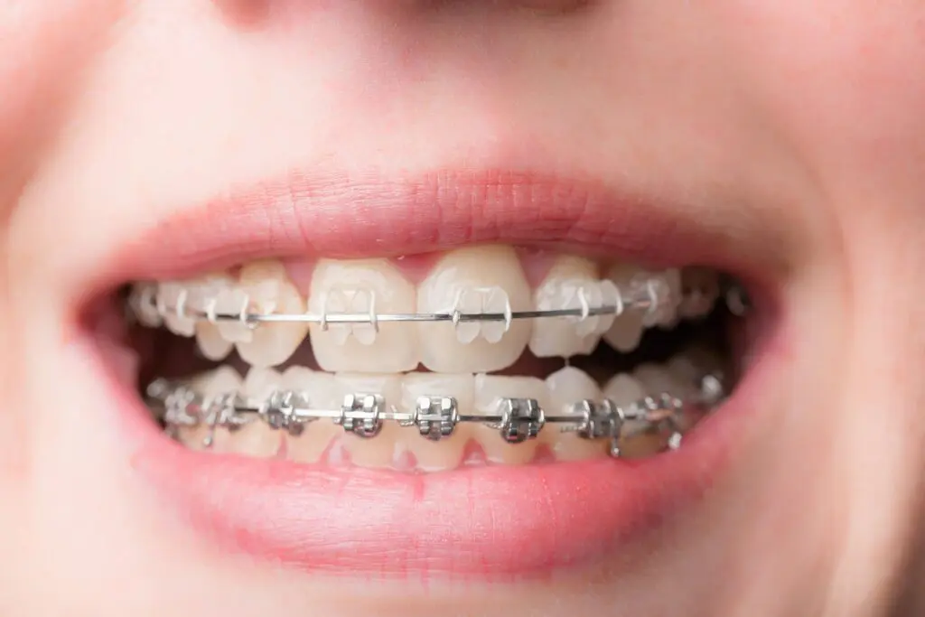 A close-up shows a person’s mouth with ceramic braces on the top teeth and metal braces on the bottom, showcasing healthy habits promoted by Orthodontic Design Co. Orthodontics for children managing an underbite in Madison and Huntsville, AL.