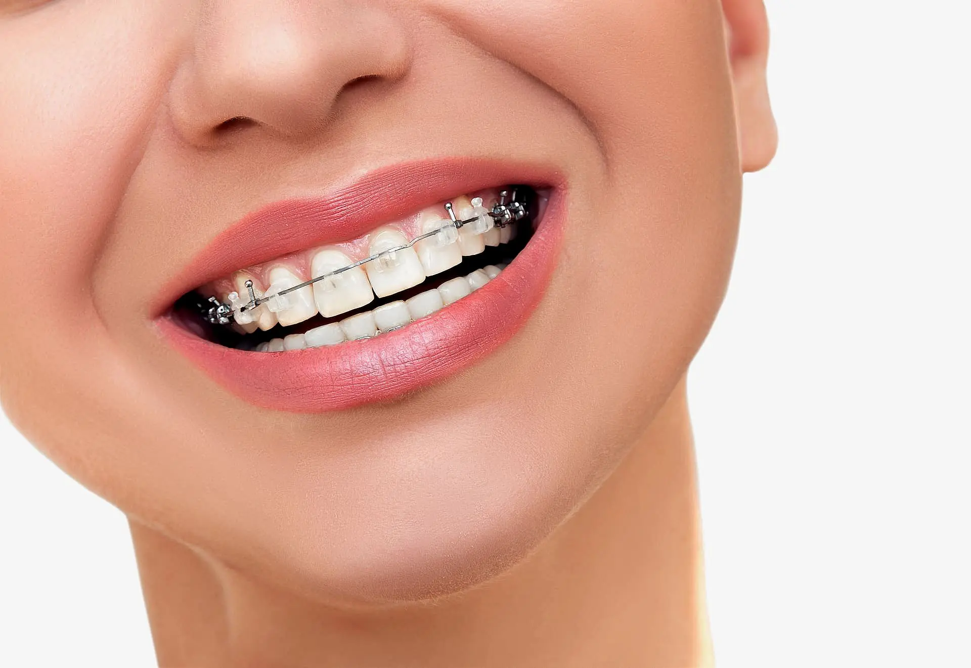 A close-up shows a person confidently smiling with Clear Braces on their teeth—an Adult Orthodontics solution—provided by Orthodontic Design Co. Orthodontics in Madison and Huntsville, AL, against a white background.