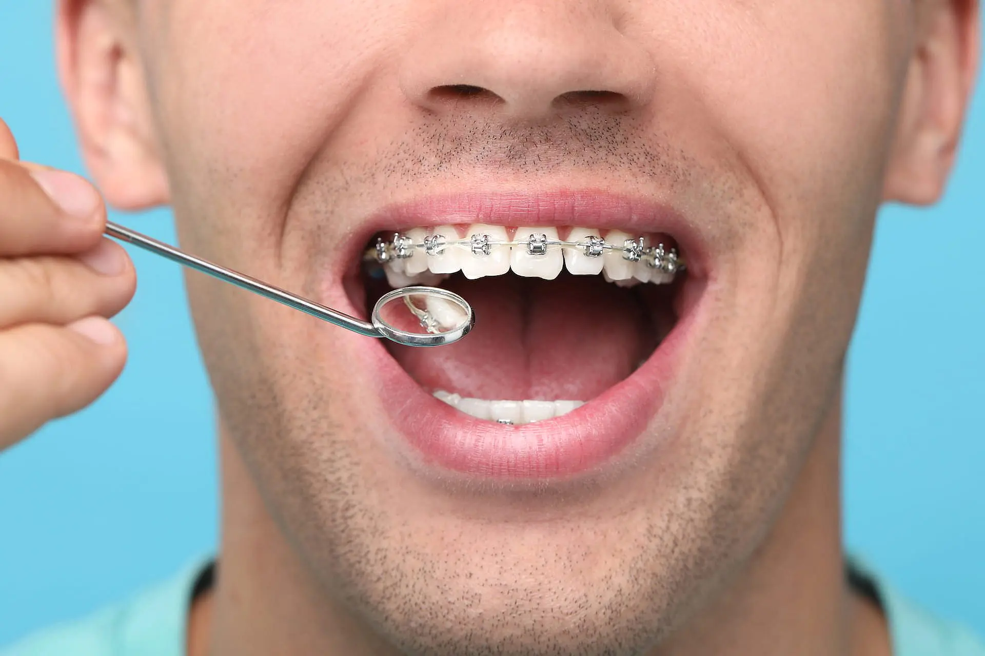 A dental mirror reflects the teeth of a person with metal braces at Orthodontic Design Co. Orthodontics in Madison and Huntsville, AL, set against a blue background, representing Adult Orthodontics.