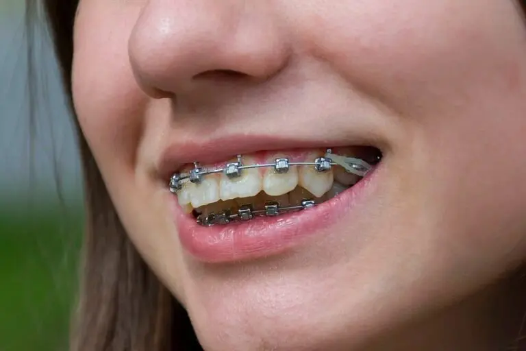 A close-up image shows a person partially smiling, revealing metal braces and elastic bands on their teeth at Orthodontic Design Co. Orthodontics' braces for overbite in Madison and Huntsville, AL.