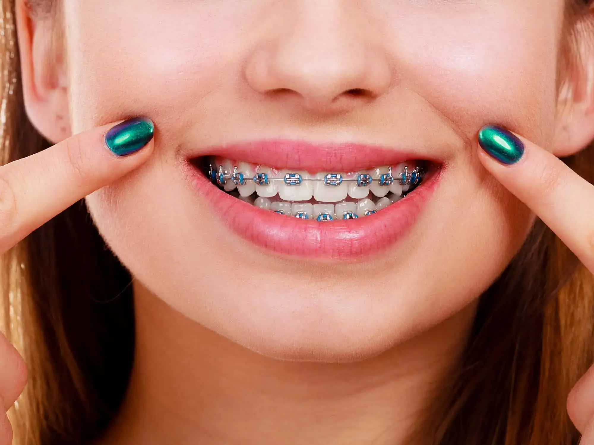 A person smiles and points at their blue braces, representing Orthodontic Design Co. Orthodontics in Madison and Huntsville, AL. A person smiles and points at their blue braces, representing Orthodontic Design Co. Orthodontics in Madison and Huntsville, AL.