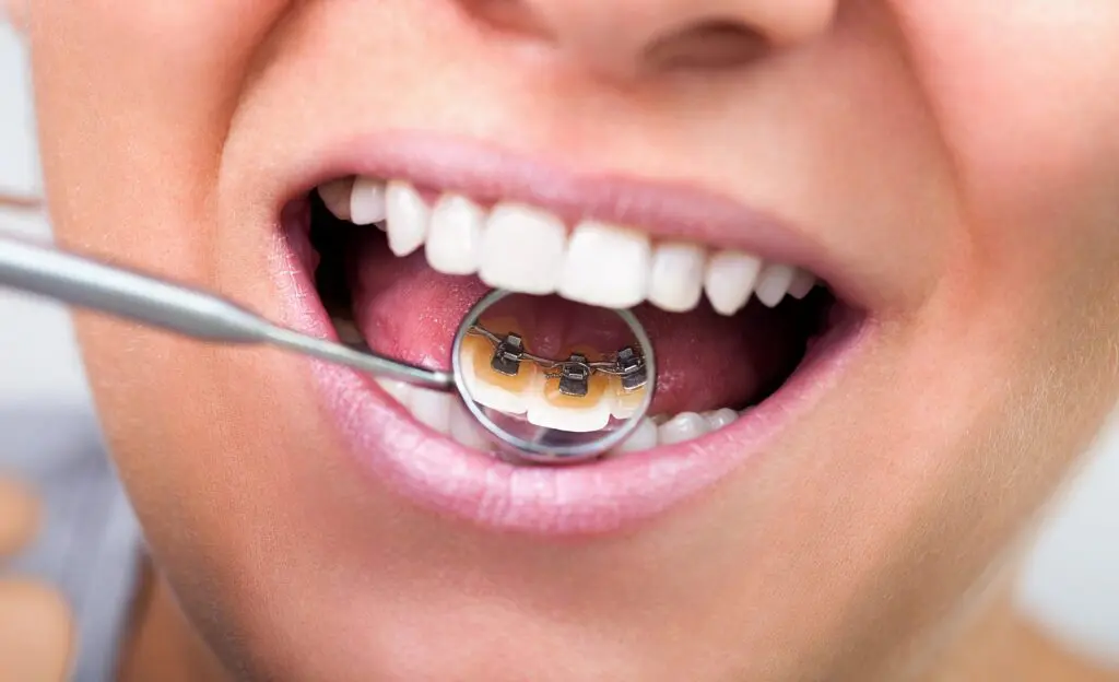 A close-up view in Madison and Huntsville, AL, shows lingual braces on the lower teeth reflected in a dental mirror held by a metal instrument at Orthodontic Design Co. Orthodontics.