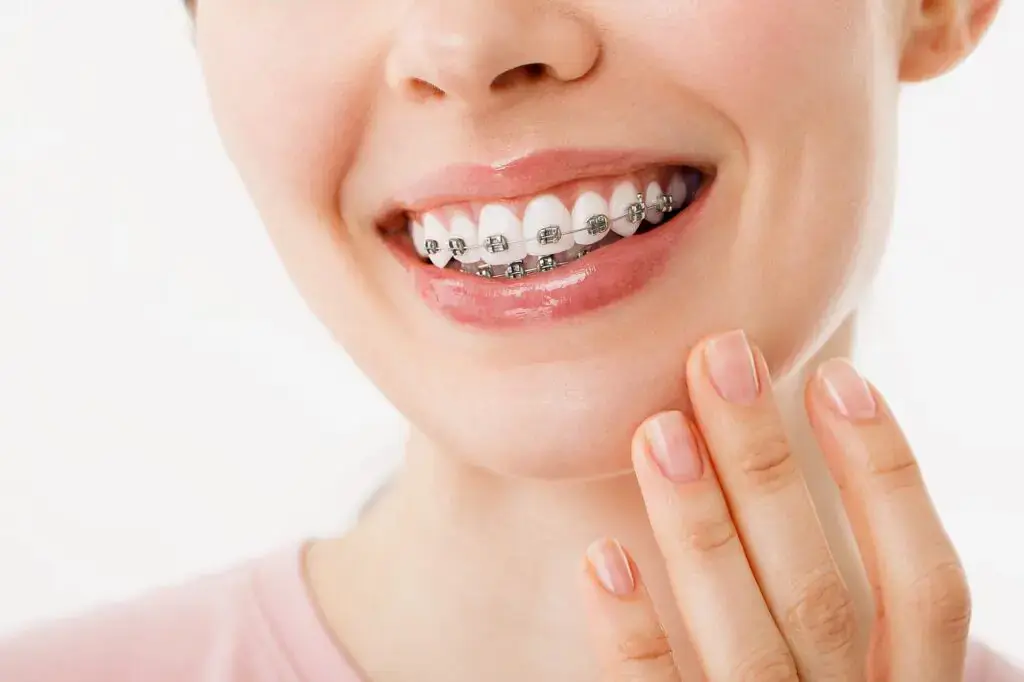 Smiling person with metal braces, hand near mouth, representing getting orthodontic insurance plans from Orthodontic Design Co. in Madison and Huntsville, AL. Smiling person with metal braces, hand near mouth, representing getting orthodontic insurance plans from Orthodontic Design Co. in Madison and Huntsville, AL.
