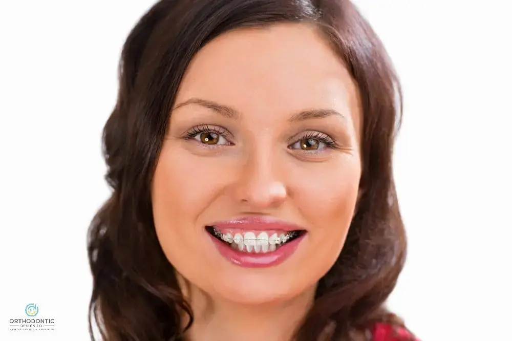 A woman with braces smiles, representing Orthodontic Design Co. Orthodontics in Madison and Huntsville, AL - Overbite vs Underbite in Madison and Huntsville, AL. A woman with braces smiles, representing Orthodontic Design Co. Orthodontics in Madison and Huntsville, AL - Overbite vs Underbite in Madison and Huntsville, AL.